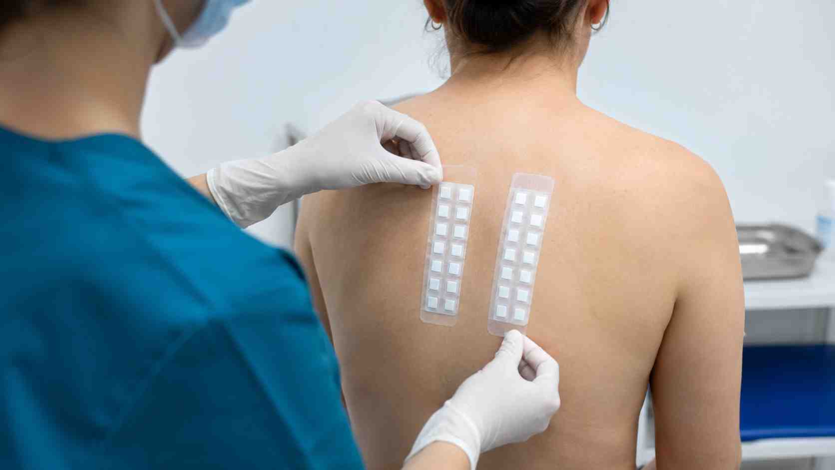 Bác sĩ dán patch test tìm dị nguyên gây viêm da tiếp xúc dị ứng